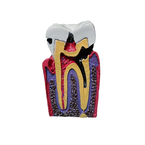 İda Collection Dental Caries Tooth Model