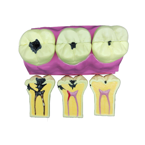 İda Collection Diş çürükleri 3 lü model