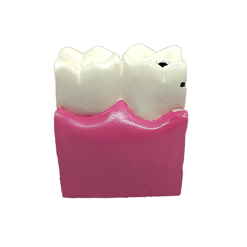İda Collection Dental Caries Tooth Model